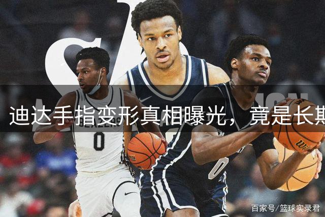 迪达手指变形真相曝光，竟是长期扑救的"勋章